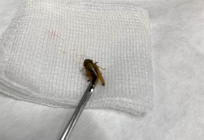 医师在小五女童耳中抓出误入耳道、长约1公分的小蟋蟀。(联新国际医院提供／吕筱蝉桃园传真)