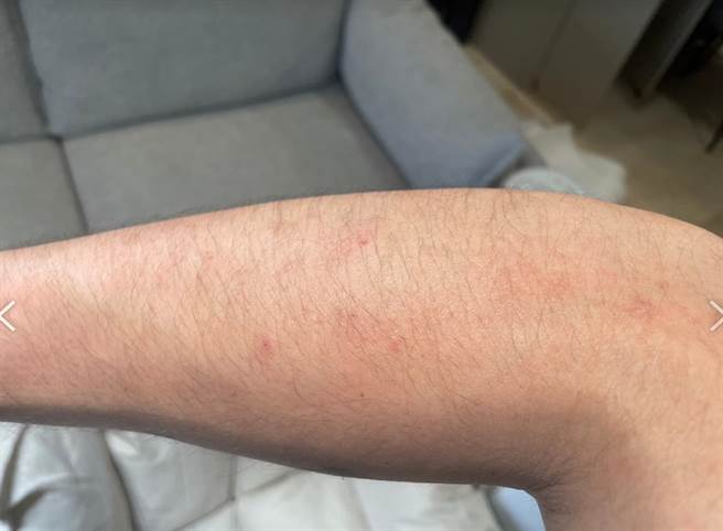 民眾刚入住新装潢的成屋，疑因建材甲醛超标，导致民眾觉得不舒服且手脚还出现红疹。（台湾住宅品质消费者保护协会提供）