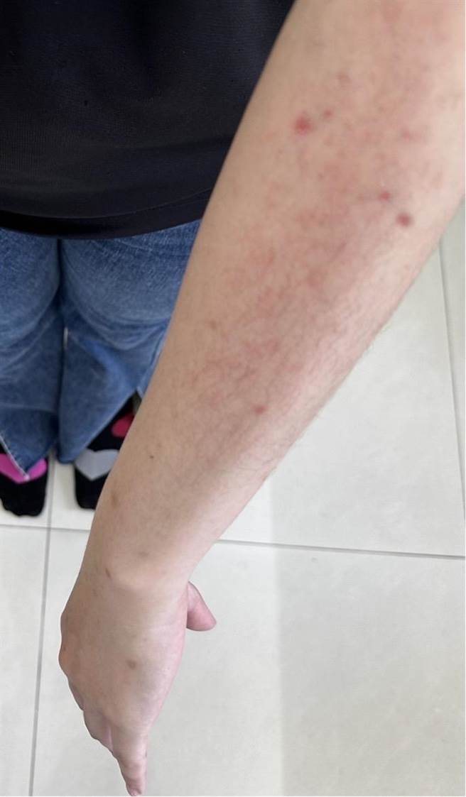 民眾刚入住新装潢的成屋，嗅出屋内散发出甲醛味，不仅觉得不舒服，且手脚还出现红疹。（台湾住宅品质消费者保护协会提供）