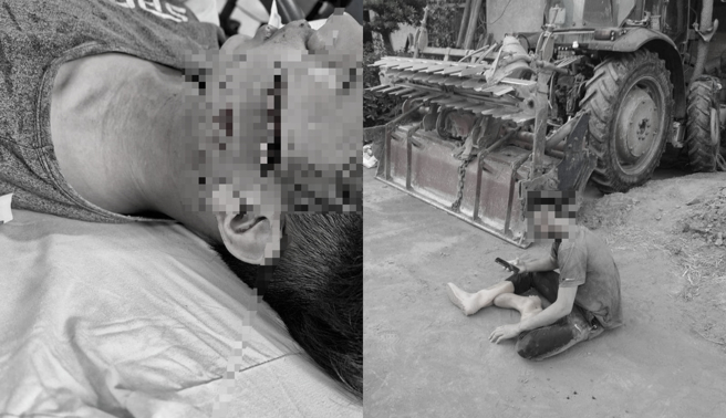 日前彰化县警溪湖分局埔盐警方执行探寻辖内非法移工勤务时，发生把17岁高中生误当逃逸移工乌龙事件，少年脸部受伤缝了17针，超巨大伤口曝光，伤口裂开从脸颊几乎快到耳朵。（民眾提供／吴建辉彰化传真）