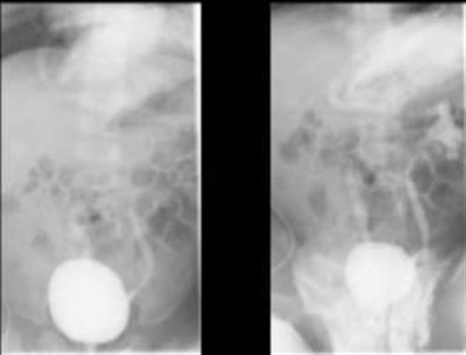 泌尿道感染和多久换尿布并无很大关系，除了细菌有可能由尿道进入体内，还有便便里的细菌也可能经由泌尿道而引发感染。（高市阮综合医院提供／杨舒婷高雄传真）