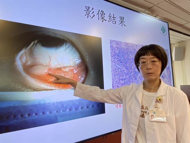 台中荣总儿童过敏免疫科医师蔡明瑾指出，龙小弟右下结膜有两个5mm大的结节，经眼科手术切除，病理切片发现是自体免疫疾病。（冯惠宜摄）