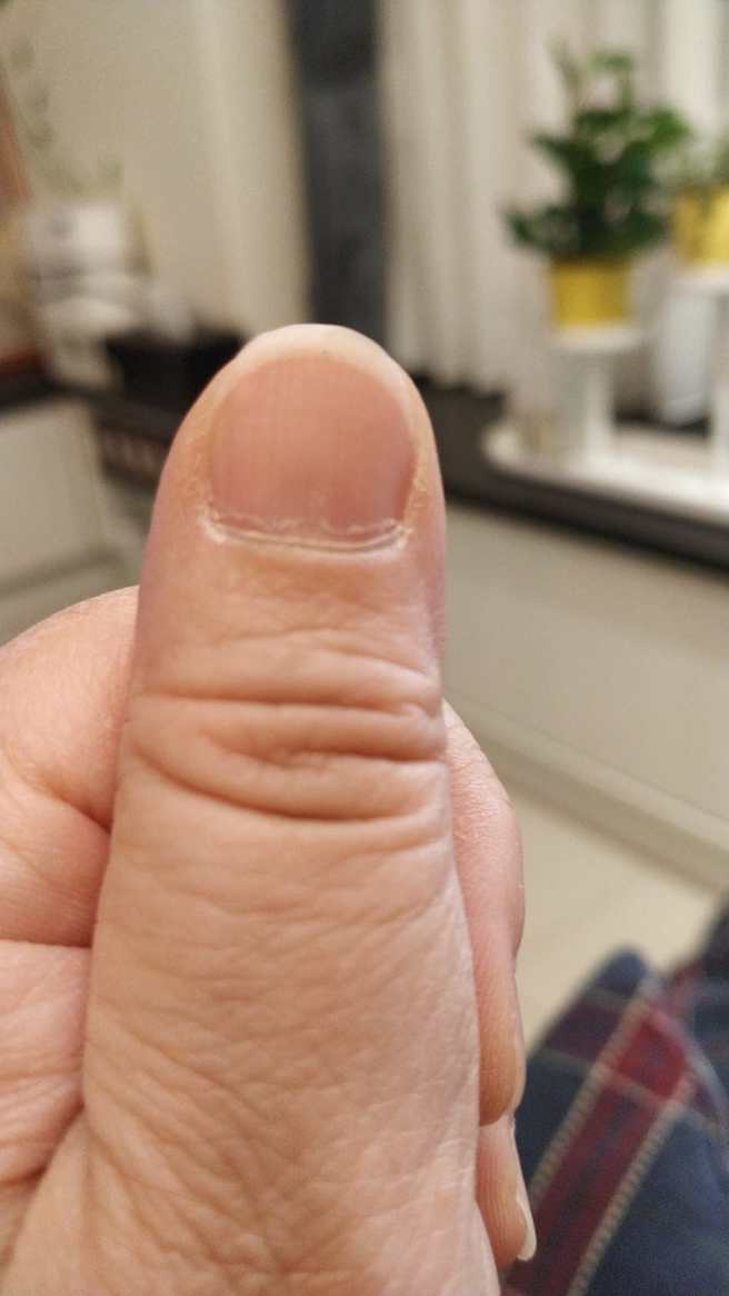 网友贴出照片，表示自己指甲最后一个月牙也消失，担心自己健康出了大问题。(图／匿名2公社)