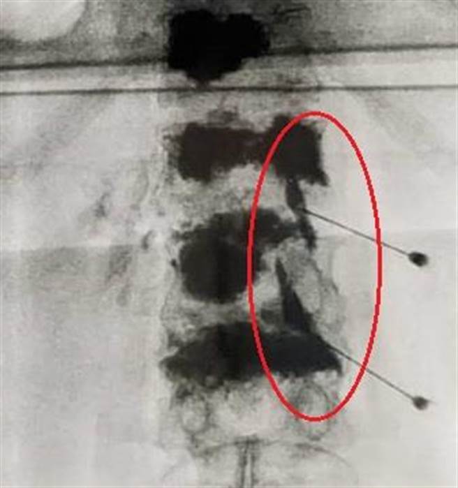 60岁苏先生1年多前曾因胸、腰椎压迫性骨折开刀，近日下背疼痛加剧，透过在背部脊椎神经根周围注射类固醇及局部麻醉药，疼痛大幅减缓。（大里仁爱医院提供／潘虹恩台中传真）