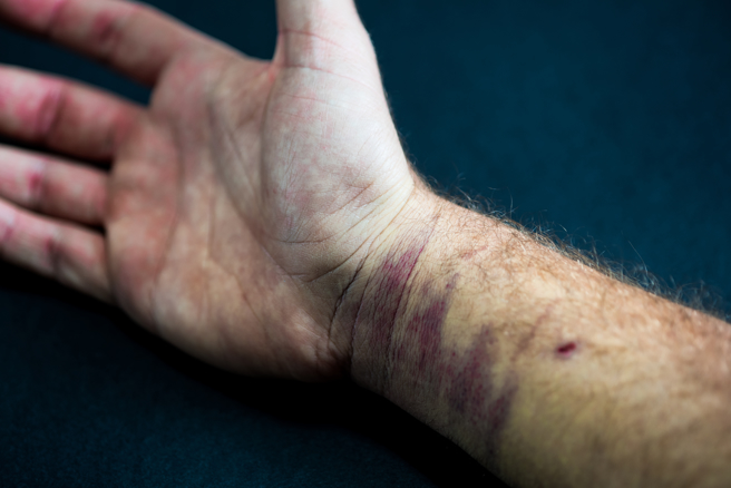 一名男子的手腕有一圈紅色瘀青。（圖／示意圖，達志影像）