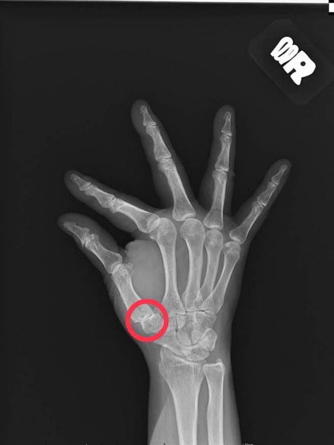 拇指的腕掌关节由许多腕骨掌骨形成关节面，提供了拇指极大的活动度及功能，但高活动度的关节若使用过度，常常使关节韧带受损及软骨磨损，进而造成骨刺与关节炎。（大里仁爱医院提供／潘虹恩台中传真）