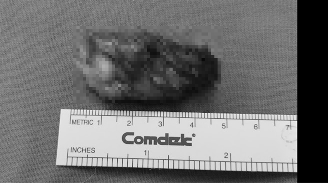 病患罹患罕见尺骨远端「骨巨细胞瘤」第3期，肿瘤约有5公分大。（乌日林新医院提供）