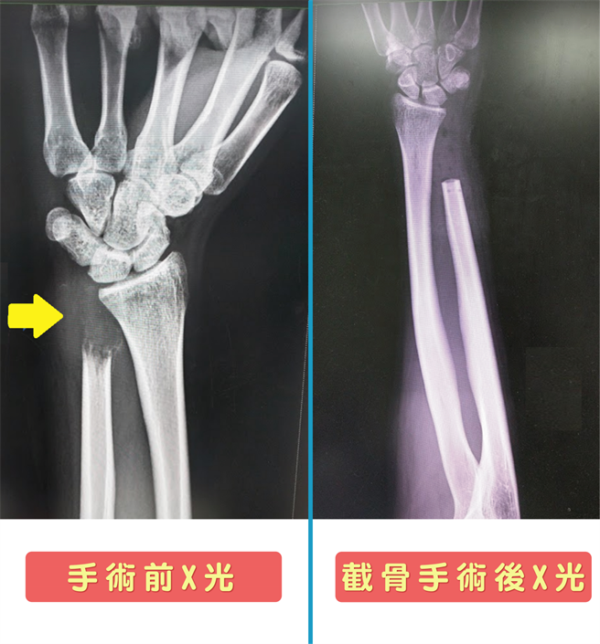 病患罹患罕见尺骨远端「骨巨细胞瘤」第3期，图为手术前、手术后照片。（乌日林新医院提供）