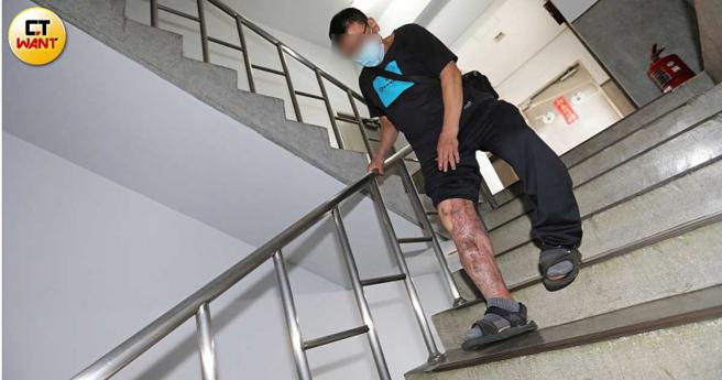 A先生苦笑因為自己腿沒斷，只有重大傷病卡，申請不到殘障手冊，但是行走不便是事實，上下樓梯舉步維艱，每每瀕臨摔倒。（圖／李宗明攝）