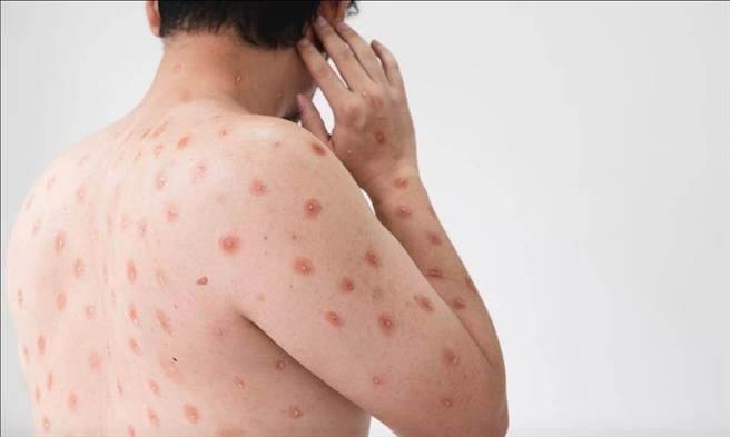 中國大陸7月新增491例猴痘確診，廣東最多北京居次。（達志影像）