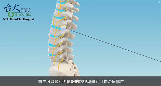 新竹台大分院引进磁导航技术，医师可以在术中即时、准确、安全的追踪手术器械及穿刺点的位置。（新竹台大分院提供／陈育贤新竹传真）