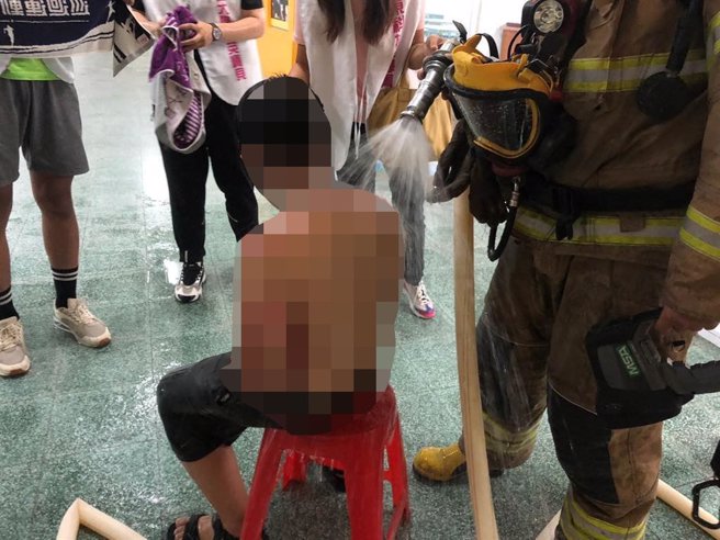 幼童背部遭灼伤。（读者提供／张毓翎台南传真）