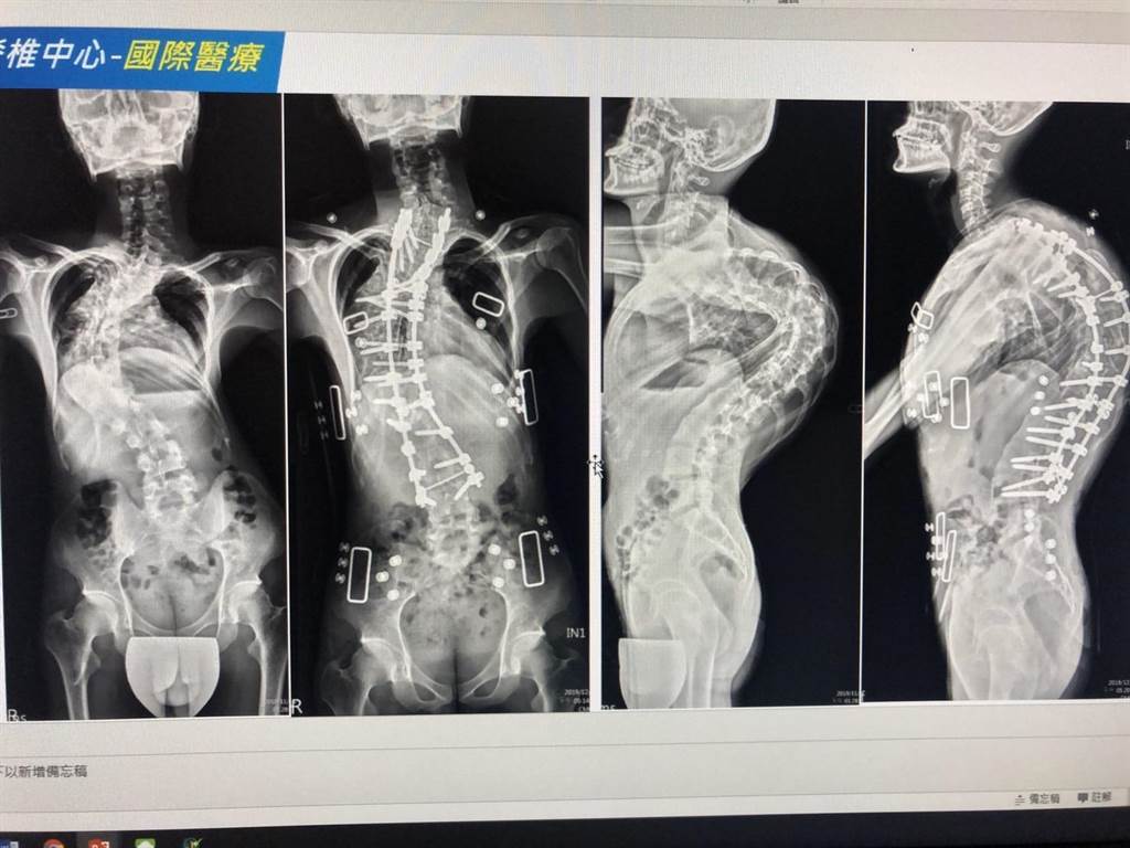 緬甸華僑玉磊曾因嚴重脊椎側彎，背部畸型如龜殼，來台治療前脊椎側彎超過100度（右），經過2次主要手術明顯改善。（中國附醫提供／馮惠宜台中傳真）