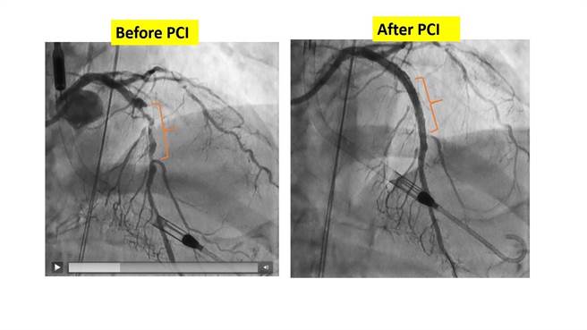 病人的冠状动脉严重钙化堵塞、成功术后的对照。（柳营奇美医院提供／张毓翎台南传真）