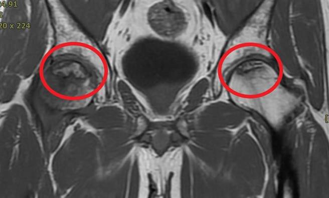 男子长期喝高粱酒，被诊断出双侧髋关节股骨头缺血性坏死。（高市活力得中山脊椎外科医院提供／杨舒婷高雄传真）