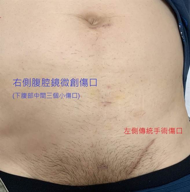 腹腔镜疝气修补手术相较于传统手术，外科医师只需利用3个微小的伤口，就可以修补疝气。（北荣新竹分院提供／邱立雅竹县传真）