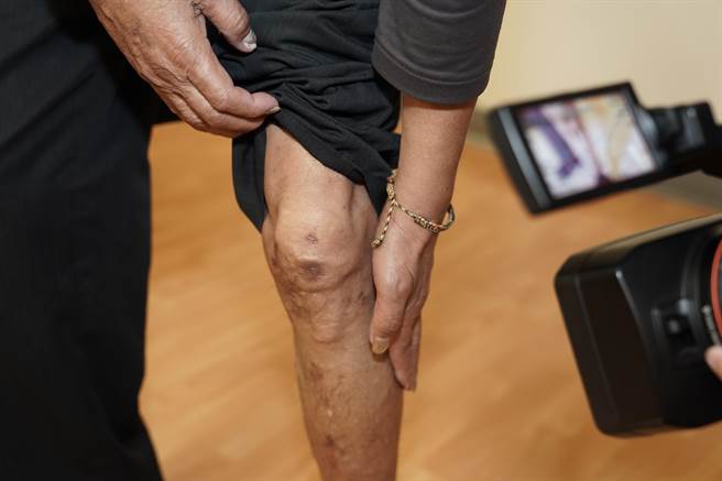 急性肢体缺血是周边动脉疾病进展到疾病末期的表现，由于不适当的肢体血流，导致病人肢体疼痛、溃疡或坏疽。（新光医院提供／林周义台北传真）