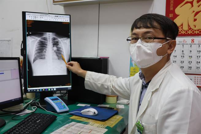 大甲李综合医院胸腔内科医师黄朝新指出，肺癌初期7成以上都没症状，目前低剂量肺部电脑断层扫瞄（LDCT）能侦测0.3 公分的肺部病变，提醒「具肺癌家族史」及「重度吸菸者」两类民眾可免费筛检。（李综合医院提供／潘虹恩台中传真）