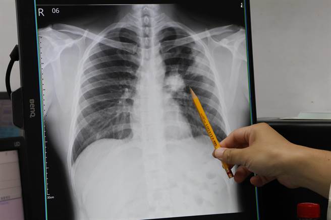 30多岁来自东南亚的男性移工工作环境常飘粉尘又有抽菸习惯，近期检查发现罹患癌症与肺结核，不过他精神、活动力佳，未感不适，连医生也惊讶「若无X光判断根本看不出来」。（李综合医院提供／潘虹恩台中传真）