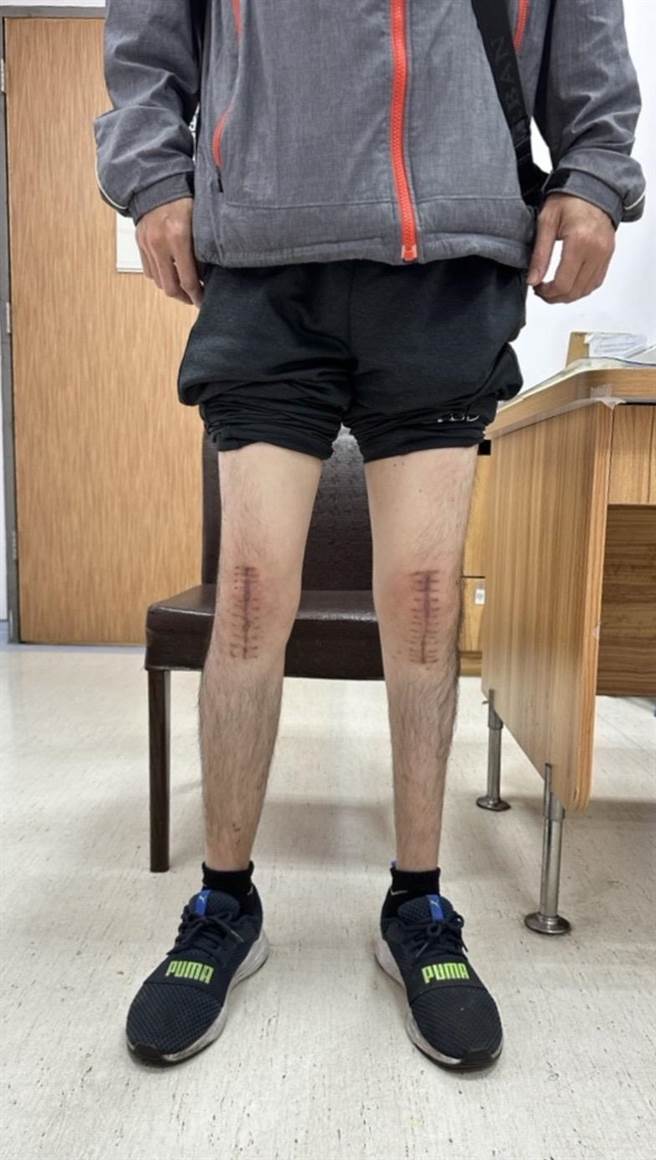 44岁的重度血友病患者陈先生去年底接受台中荣总一次性同时双膝关节置换手术，从跛脚变勇脚。（台中荣总提供／冯惠宜台中传真）