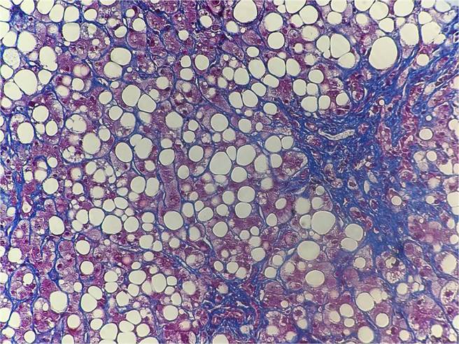 澄清医院胃肠肝胆科医师吴明骏表示，经肝臟切片在这名36岁患者肝臟发现多个大颗泡泡状结构，肝臟被大量脂肪细胞浸润，有肝臟衰竭的情形。（澄清医院提供／冯惠宜台中传真）