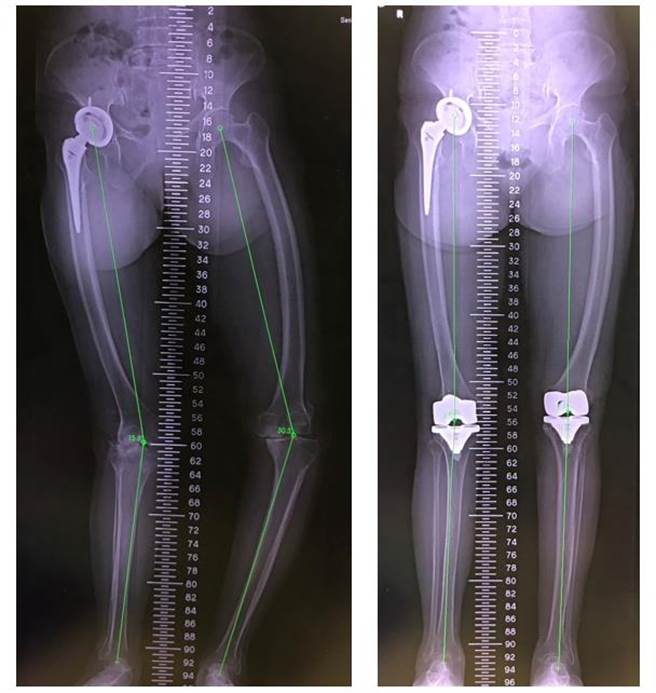 李阿嬤右膝關節的膝外翻變形大於15度且左膝關節的膝內翻變形大於30度（左圖），幸經微創膝關節置換手術成功恢復筆直雙腿，走路也不再歪斜、常跌倒（右圖）。（大里仁愛醫院／潘虹恩台中傳真）