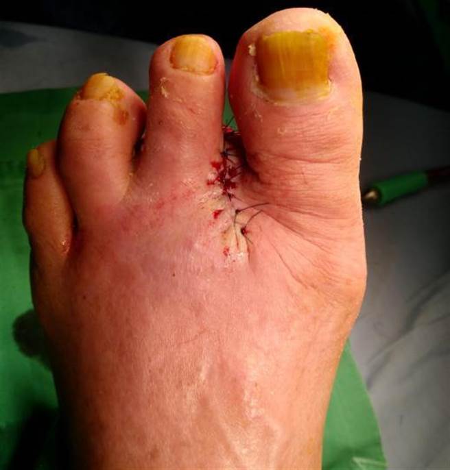 陈姓妇人为不让伤势恶化，最后选择截跂，幸运的是不影响日常生活。（光田综合医院提供）