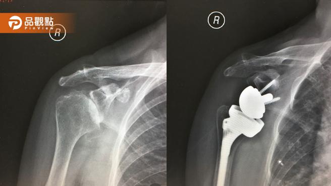 （左图）患者长期肩关节疼痛，诊断罹患退化性肩关节炎。（右图）患者接受反式人工肩关节置换手术，与传统人工肩关节相反的特殊设计，把关节盂变成球头，肱骨变成凹窝。（图片来源：中正骨科提供）