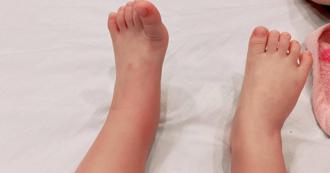 3歲童突然發燒 因1物染「蜂窩性組織炎」 住院才治好  