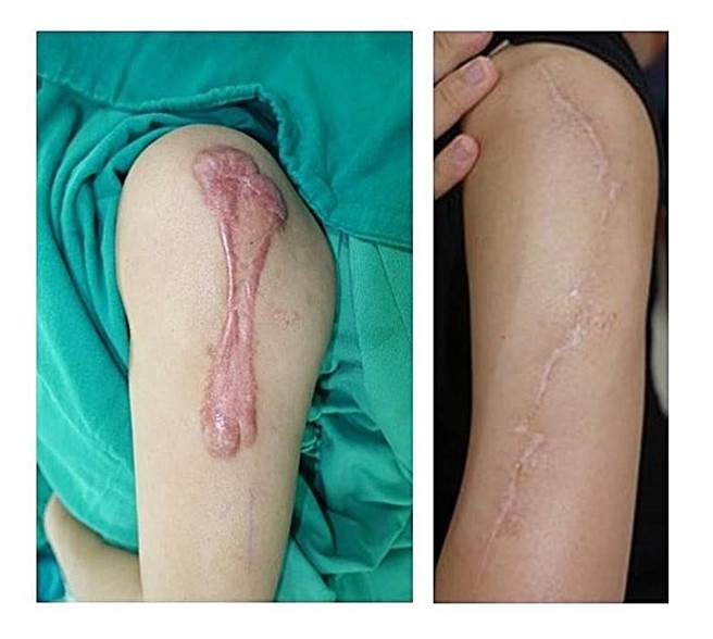 40岁的谢小姐13岁后因卡介苗上手臂长出「蟹足肿」，两年前经大里仁爱医院整形外科蟹足肿团队手术切除与术后放射治疗，终于可以解放手臂。（台中大里仁爱医院提供／冯惠宜台中传真）