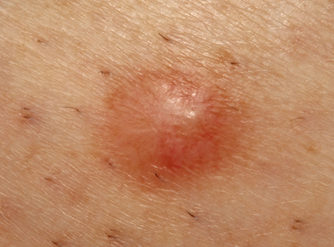 一名男子小腿长了2、3公分的瘤，因该颗瘤越长越大且变硬，所以手术切除后，但男子2年后又在大腿长了一颗新的恶性脂肪肉瘤，最后只能截肢保命。(示意图/ Shutterstock )