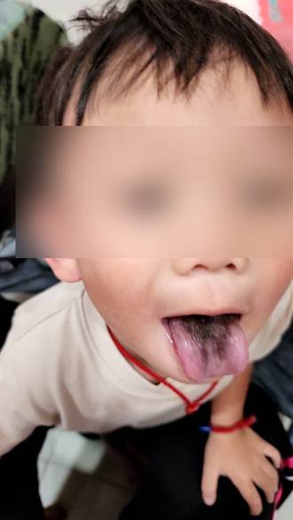 驚！4歲男童嘴長「黑毛舌」 媽媽嚇壞、醫揪原因