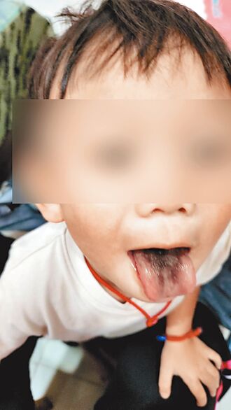服用10天抗生素 男童舌頭竟長黑毛