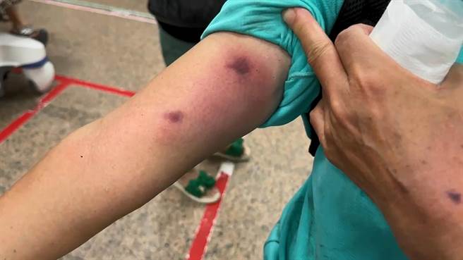 疑似遭土蜂攻击的民眾送医急救，目前都没有大碍，但被蜂螫的伤处都立即紫黑红肿。（张志康摄）