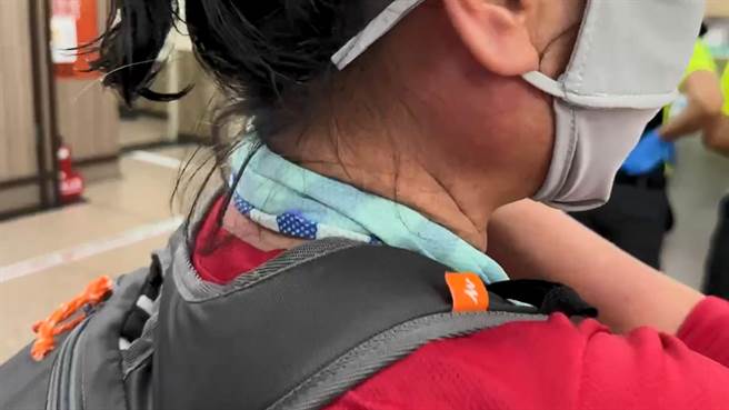 疑似遭土蜂攻击的民眾送医急救，目前都没有大碍，但被蜂螫的伤处都立即紫黑红肿。（张志康摄）