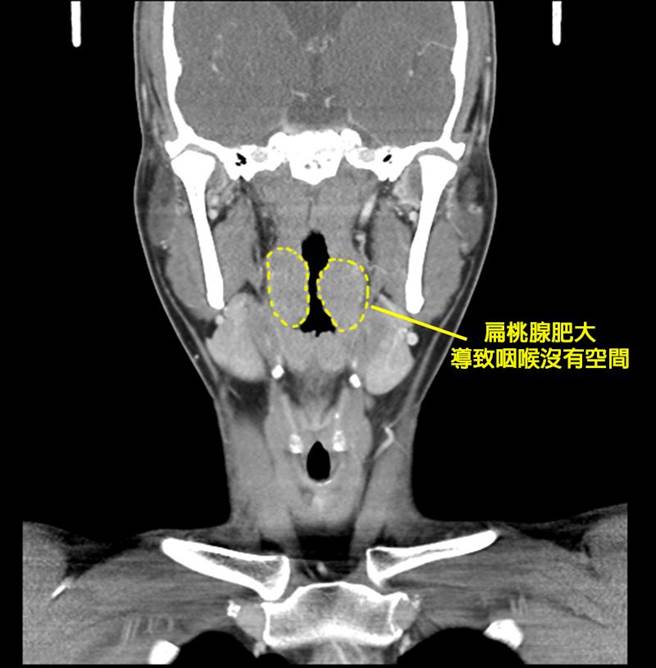 澄清医院耳鼻喉科主任徐毓婷指出，经检查这名阿兵哥两侧扁桃腺几乎kiss在一起。（澄清医院提供／冯惠宜台中传真）