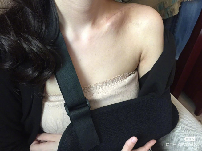 王乐君透露锁骨上的伤疤难消除。（图／翻摄自是段小姐来了微博）