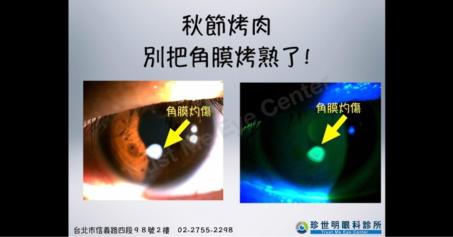 一名男子烤肉时，被木炭烧灼爆裂喷出的火星直接触及眼角膜，瞬间角膜蛋白被烤熟。(图/ 眼科医师王孟祺提供)