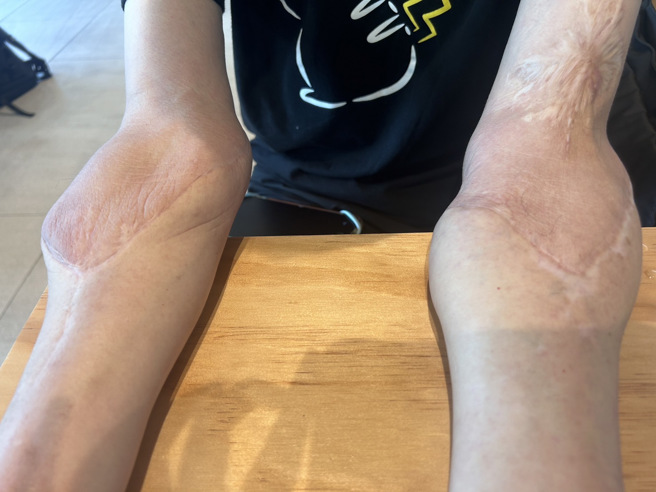 受访当日，王致远身着短袖短裤，移植双臂上也看见疤痕生增、顏色浅深、陆续生长的新肉。（照片 / 刘咏韵拍摄）