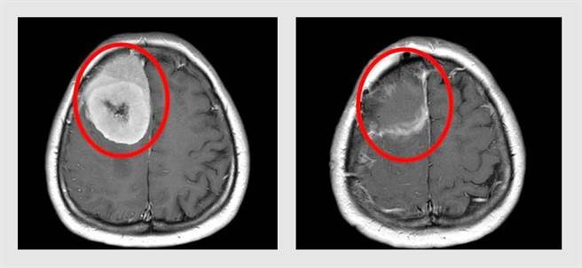 65岁吴小姐近年有头痛、头晕与视力模糊等症，误以为是眼压过高所致，进一步检查才发现脑中右侧前额叶长出1颗直径9公分巨大脑瘤。（大里仁爱医院提供／潘虹恩台中传真）