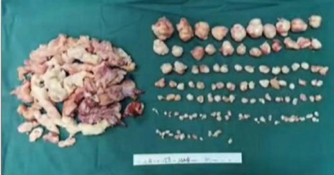 大陸陝西西安一名50歲張姓女子，10年前檢查出子宮肌瘤沒理會，沒想到近2年卻出現頻尿、月經增量，就醫檢查後發現體內竟有109顆子宮肌瘤。（圖／抖音）