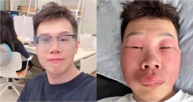 北京郑姓男子长期挖鼻孔，日前脸部突然严重红肿疼痛，有如猪头，惨不忍睹。（翻摄微博＠中国网看点）