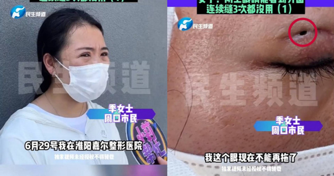 季女控诉医美诊所手术疏失，导致自己眼皮开了个大洞，就算闭眼还是能看到外面，相当崩溃。(图／取自微博)