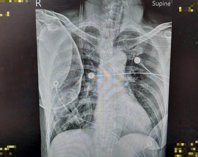 病患失去呼吸心跳后，经CPR及电击才顺利恢復自发性心律，但呈现深度昏迷状态。（大千医院提供／谢明俊苗栗传真）