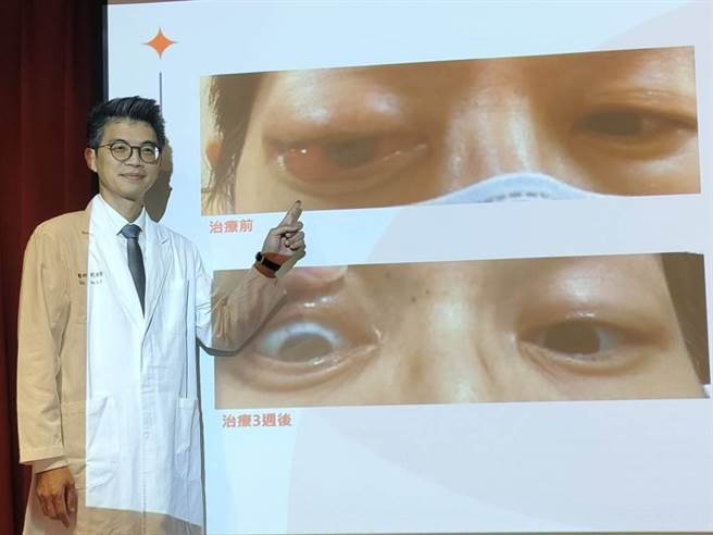 中国医药大学附设医院乳房外科医师刘良智表示，小宛罹「HER2弱阳性乳癌」癌细胞转移至眼窝，接受「魔术子弹」ADC药物治疗不到1个月获大改善。（潘虹恩摄）