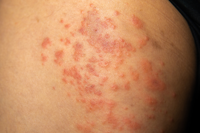 一名患者因皮肤溃烂20年，遍寻名医都找不出原因、也治不好。(示意图/ Shutterstock )