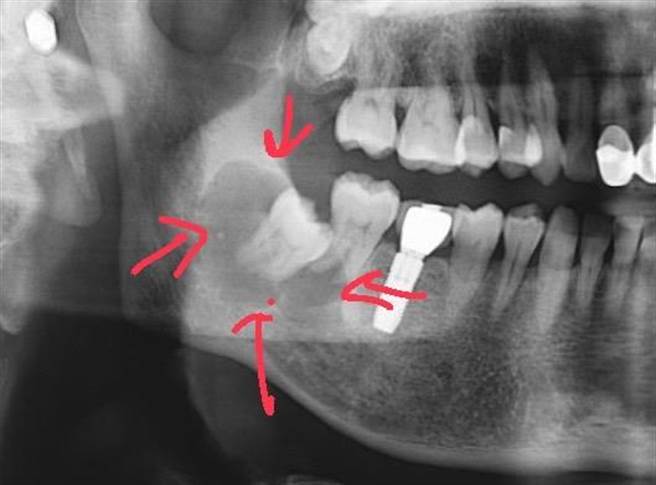 许多民眾因为长智齿而苦恼，图为一名患者到牙科就医后，从Ｘ光影像发现右下智齿周边有异常病灶，高医医师蔡承熹发现有3、4公分大小的囊肿，已将未长出的智齿包覆住。为避免进一步造成颚骨破坏，医师安排全身麻醉刮除囊肿部位，并将智齿及邻近已被波及的第二大臼齿一併拔掉。（高医冈山医院提供／林瑞益高雄传真）