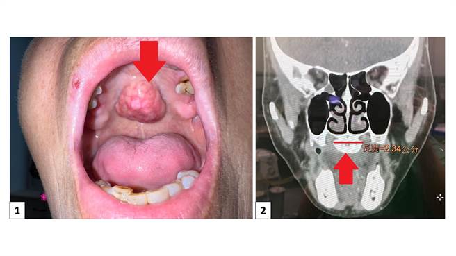 53岁张女士日前发现口腔上颚处长出1颗巨大硬块影响装设活动假牙，经检查诊断为「颚骨隆突」，幸手术切除恢復成平坦、正常状态。（大里仁爱医院提供／潘虹恩台中传真）