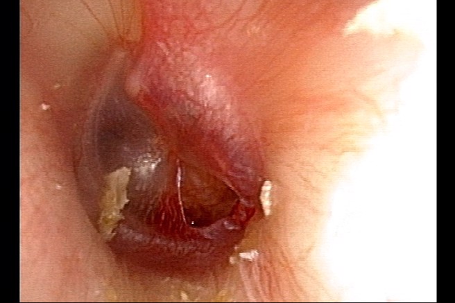 耳膜穿孔图示，非当事人（图片来源：双和医院）