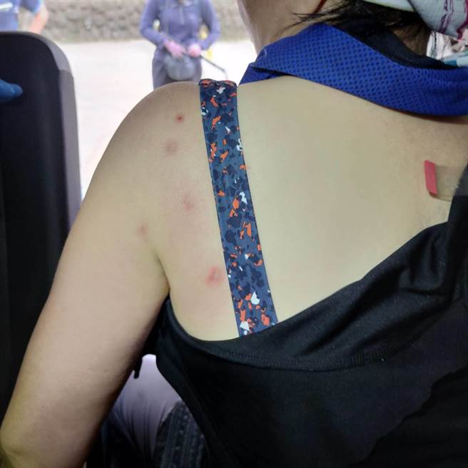 登山客背部多处遭蜂螫。（民眾提供／李京升苗栗传真）